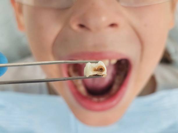 Best Emergency Treatment for Dental Infections or Abscesses in Midland, NC
